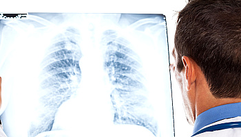 Rak płuca najczęściej rozpoznawalnym nowotworem złośliwym